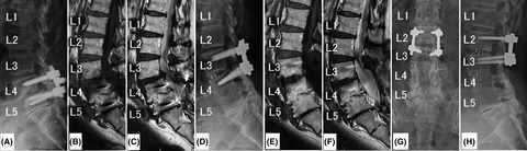 Three cases of adjacent segment disease post-posterior spinal fusion, treated successfully by oblique lateral interbody fusion: A clinical series