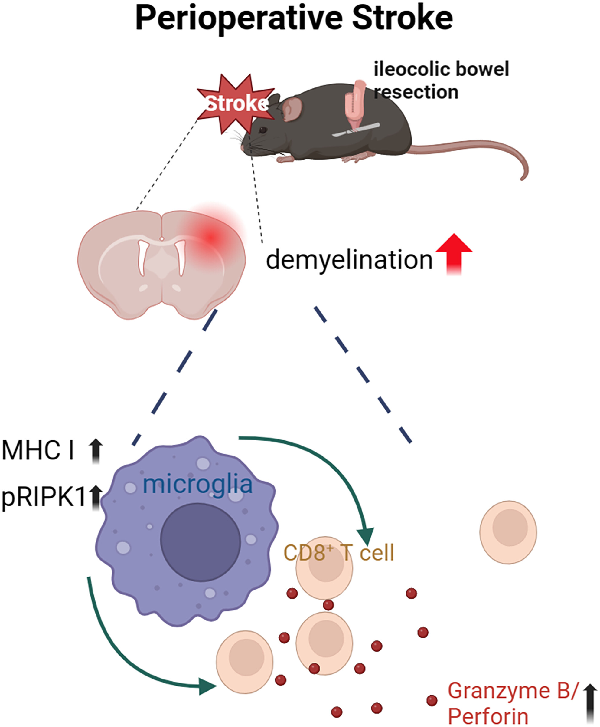 Perioperative stroke deteriorates white matter integrity by enhancing cytotoxic CD8+ T-cell activation