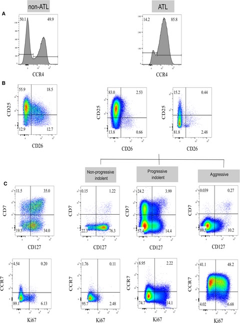 Risk stratification of adult T-cell leukemia/lymphoma using immunophenotyping