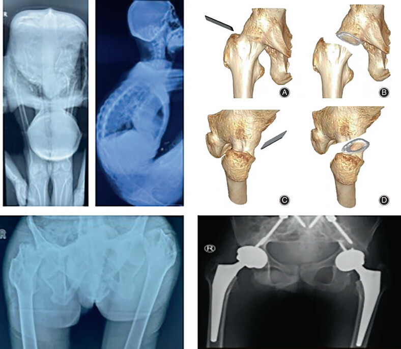 A Femoral Neck Osteotomy for the Patients with Ankylosing Spondylitis and Thoracolumbar Kyphosis Combined with Hip Flexion Contracture