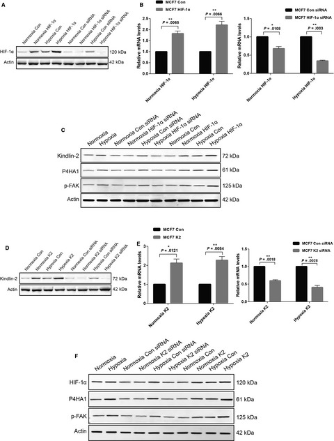 HIF-1α interacts with Kindlin-2 and influences breast cancer elasticity: A study based on shear wave elastography imaging