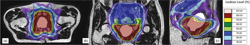 Post-Prostatectomy Magnetic Resonance-Guided Radiotherapy on a 1.5 Tesla Magnetic Resonance Integrated Linear Accelerator: Feasibility, Toxicity, and Preliminary Clinical Outcomes