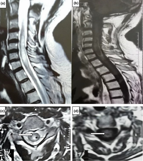 Radiological characteristics of neuromyelitis optica spectrum disorder in Egypt