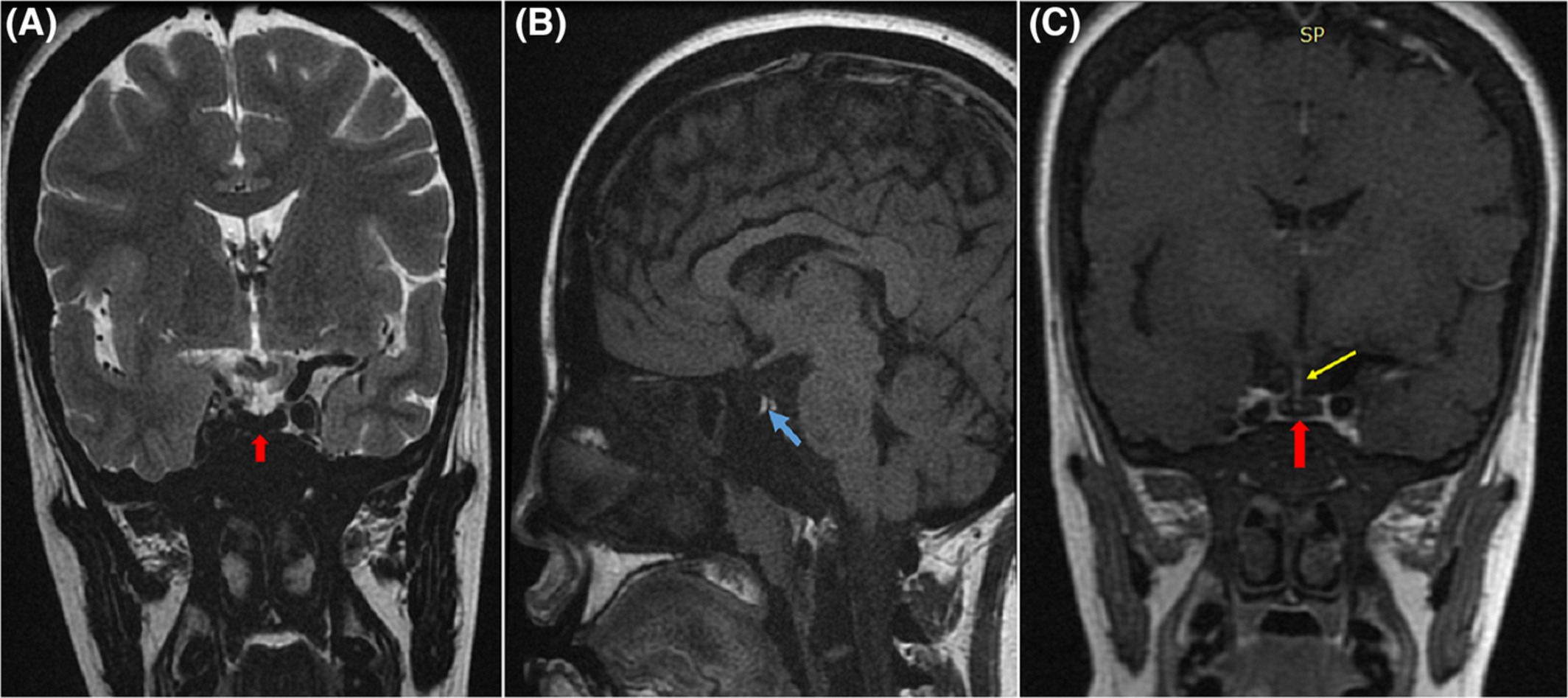 Pituitary hyposignal characteristic of hemochromatosis on MRI