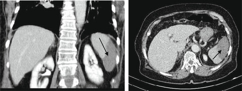 Post-COVID-19 splenic infarction in a patient with chronic atrial fibrillation: A case report