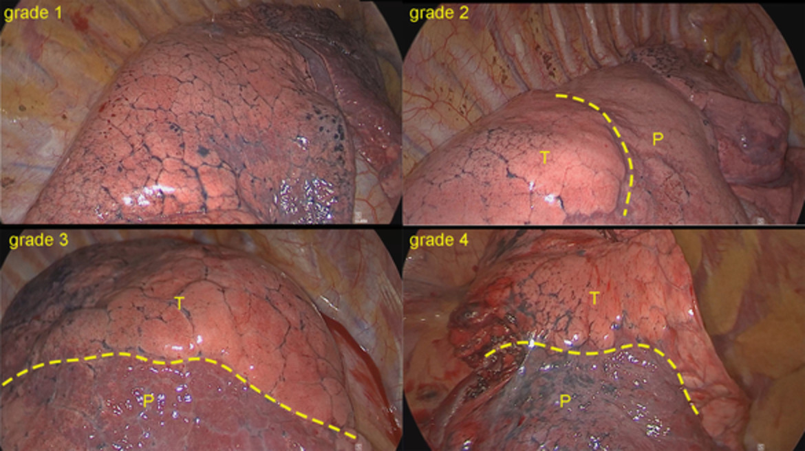 Combination of nitrous oxide and the modified inflation-deflation method for identifying the intersegmental plane in segmentectomy: A randomized controlled trial