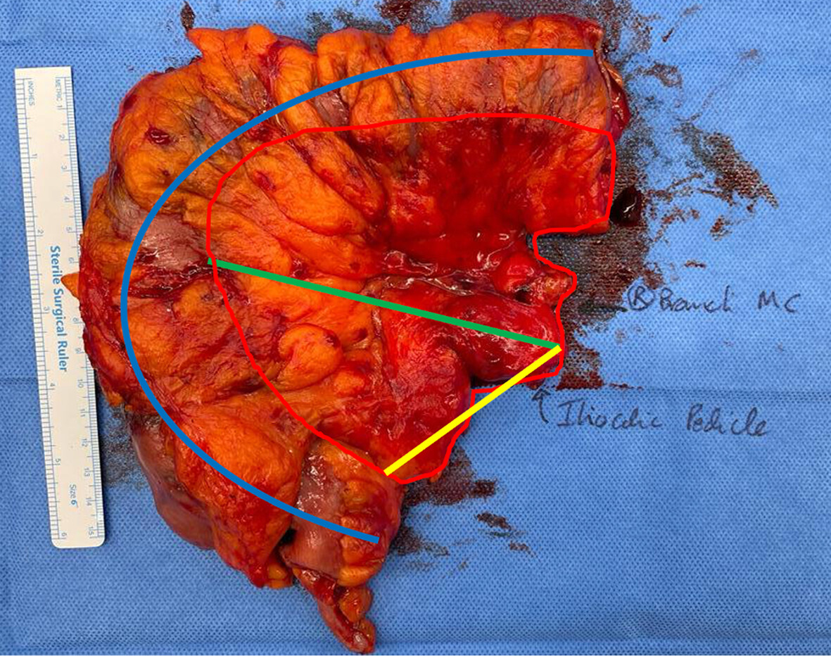 Complete mesocolic excision for colon cancer: current status and controversies Issue 3, 2024