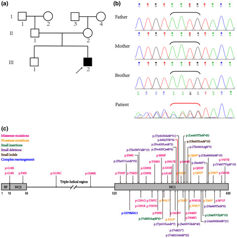 Characterization of a novel COL10A1 variant associated with Schmid-type metaphyseal chondrodysplasia and a literature review