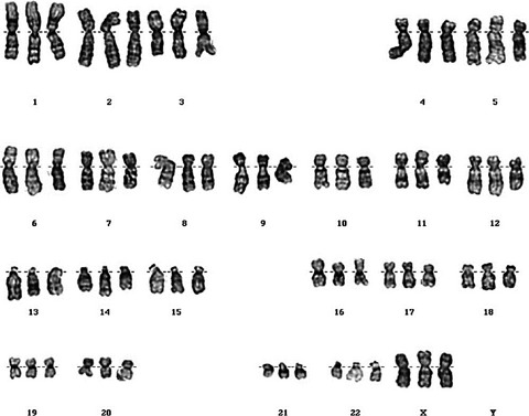 Counting-based cell-free DNA screening test fails to identify triploidy—A case report