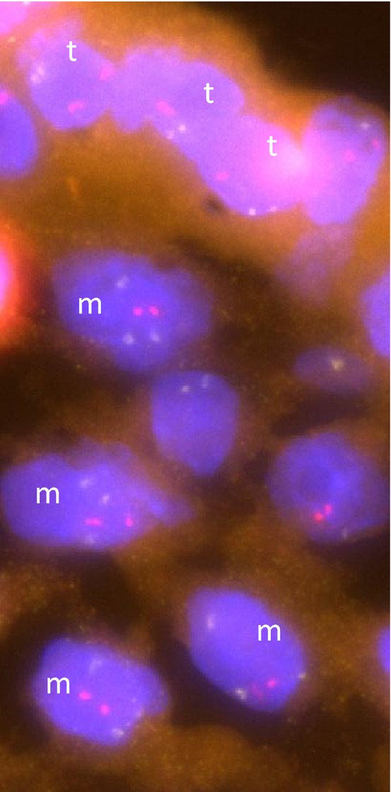 Cell-free fetal DNA in the maternal circulation originates from the cytotrophoblast: proof from an unique case