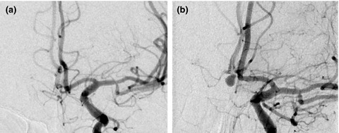 Cerebral aneurysm: De novo genesis and rupture within 15 days