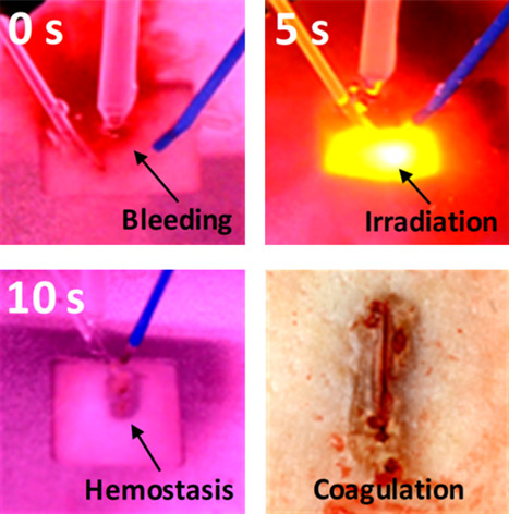 Dual-wavelength-assisted thermal hemostasis for treatment of benign prostate hyperplasia
