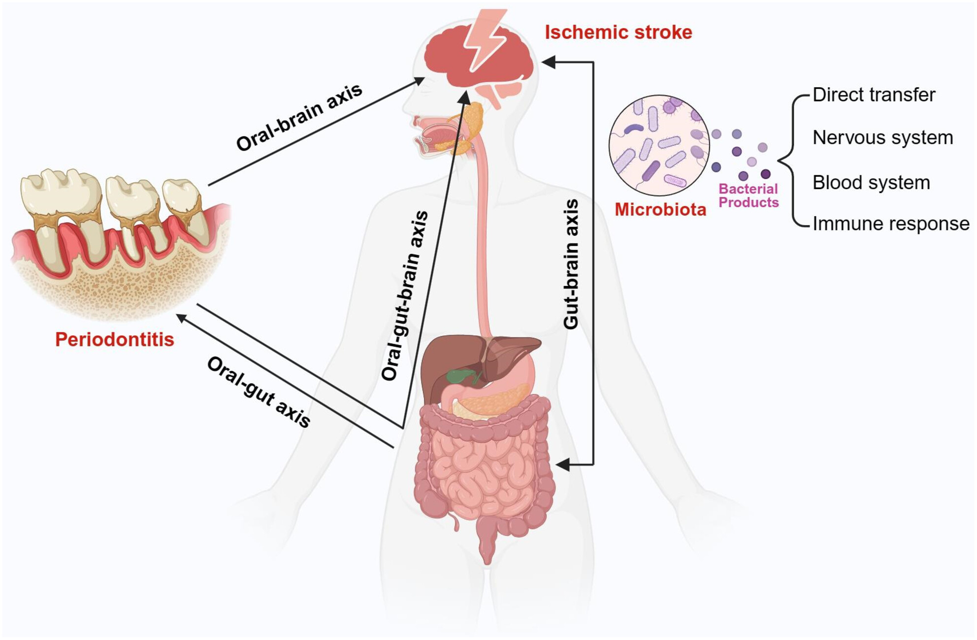 The Oral–Gut–Brain Axis: The Influence of Microbes as a Link of Periodontitis With Ischemic Stroke