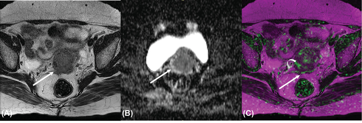 Prediction of response to radiotherapy in locally advanced carcinoma cervix using multiparametric MRI: A prospective, single-center, longitudinal study