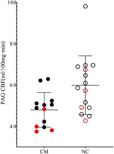 Hypoperfusion of periaqueductal gray as an imaging biomarker in chronic migraine beyond diagnosis: A 3D pseudocontinuous arterial spin labeling MR imaging