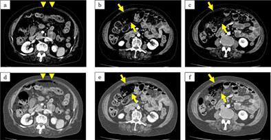 Case of pneumatosis cystoides intestinalis with intra-abdominal free air developed during treatment with voglibose