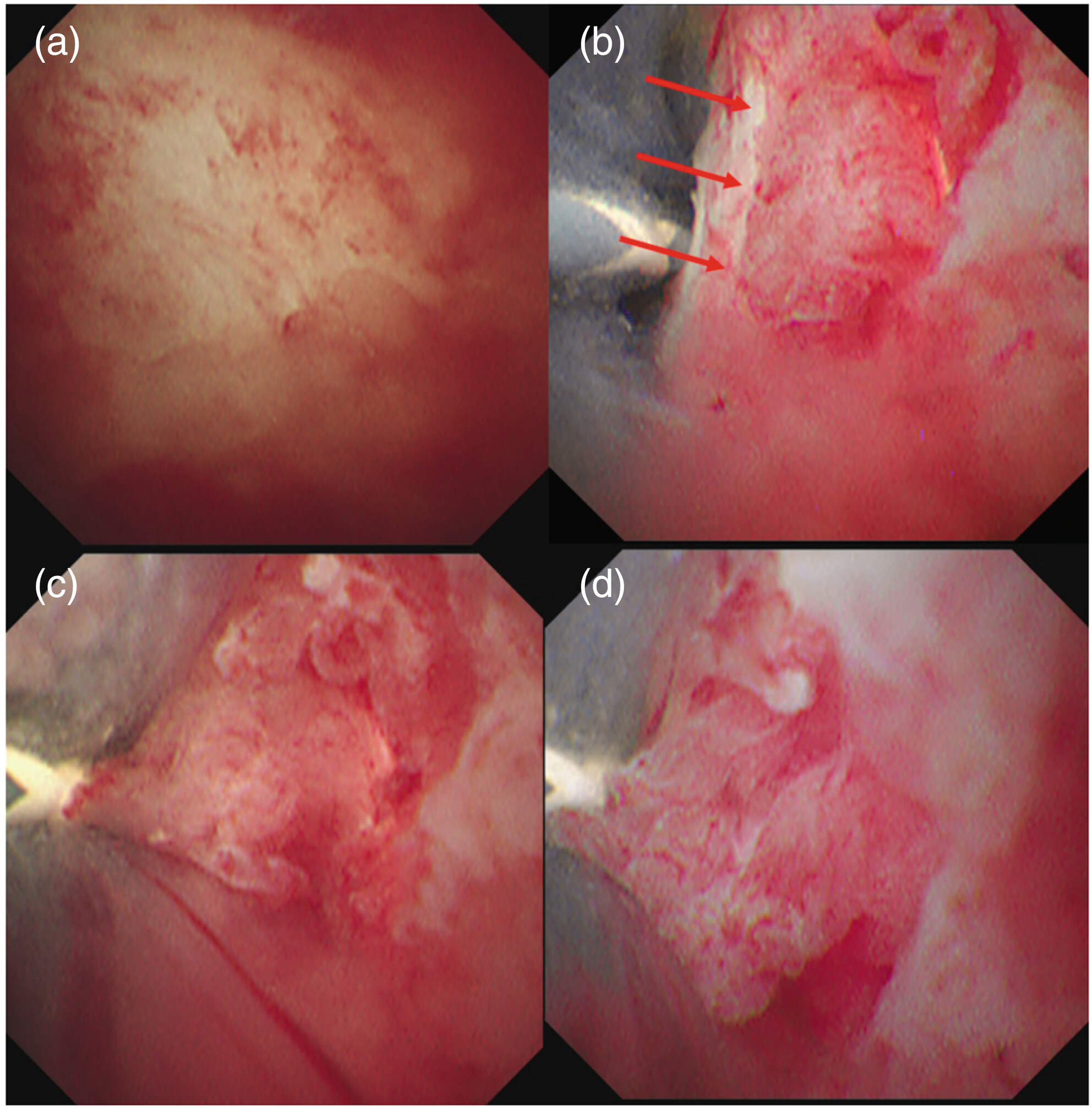Usefulness of texture and color enhancement imaging in peroral pancreatoscopy