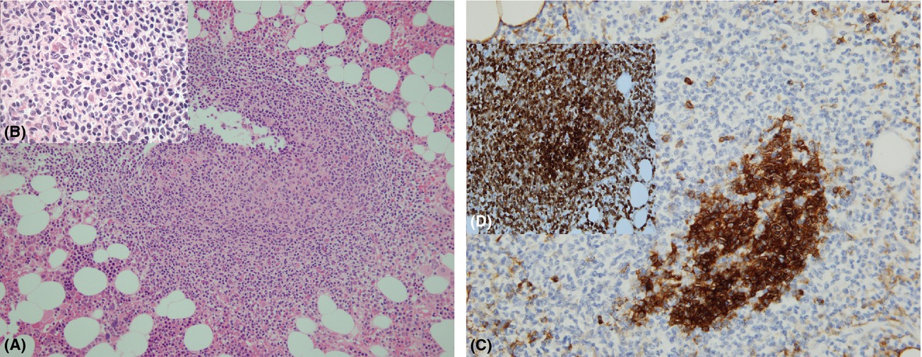 Follicular lymphoma (in situ) pattern in the bone marrow: does it indicate an early stage in disease evolution?