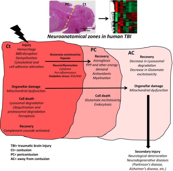 Neuroanatomical zones of human traumatic brain injury reveal significant differences in protein profile and protein oxidation: Implications for secondary injury events