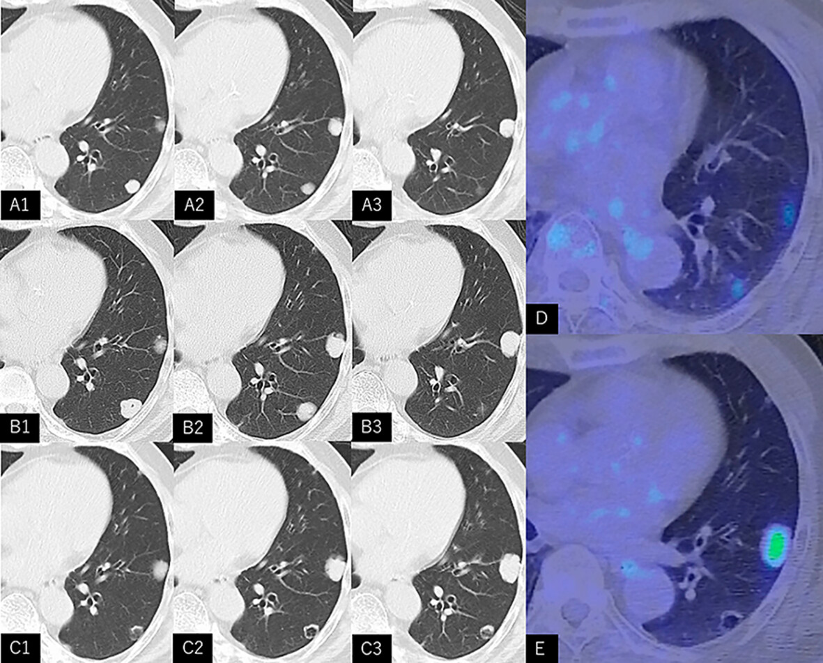 A Case of Cavitary Lung Metastasis From Prostate Cancer