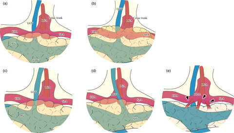 Surgical approaches for minimally invasive distal pancreatectomy: A systematic review
