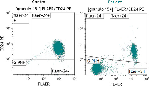Abdominal pain in combination with an unexplained hemolytic anemia are crucial signs to test for paroxysmal nocturnal hemoglobinuria: A case report