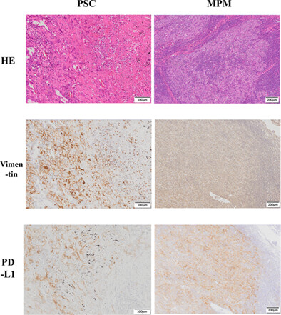 Thoracic mesenchymal malignant tumors and programed cell death ligand-1 status: Clinicopathologic and prognostic analysis of eight pulmonary sarcomatoid carcinomas and eight malignant mesotheliomas