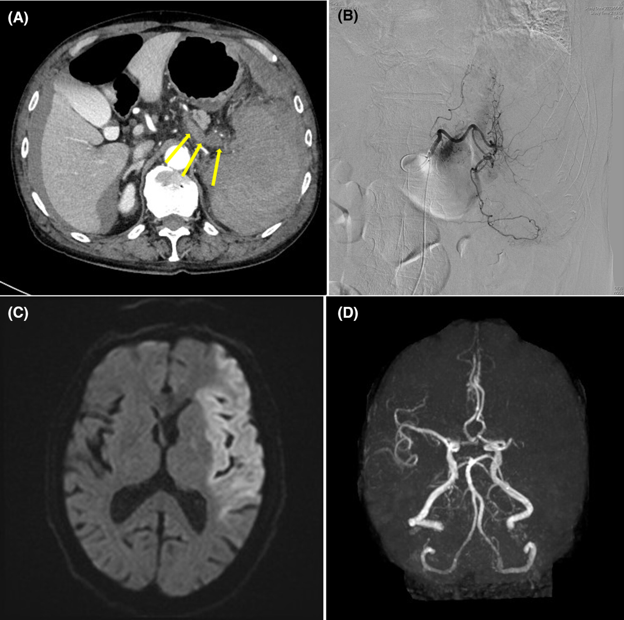 Spontaneous splenic rupture due to occult signet-ring cell gastric cancer accompanied by a bulky splenic vein thrombosis and postoperative brain infarction: A case report