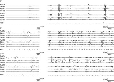 Abnormal function of the UBA5 protein in a case of early developmental and epileptic encephalopathy with suppression-burst