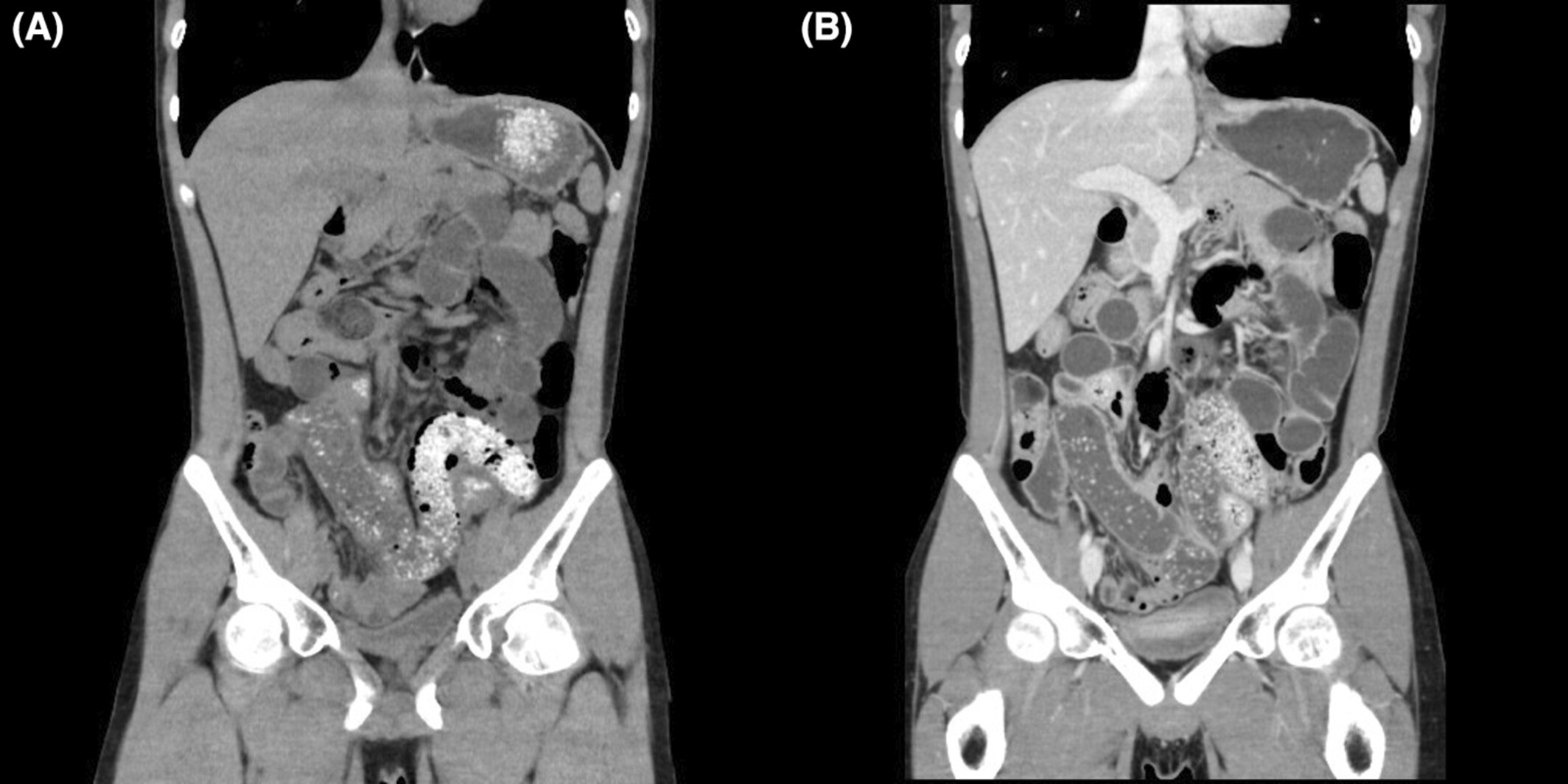 Intestinal obstruction caused by consuming diet food containing psyllium