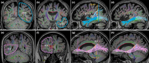 Visual hallucinations and inferior longitudinal fasciculus in Parkinson's disease