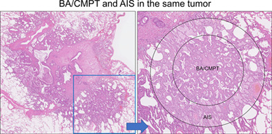 Bronchiolar adenoma/ciliated muconodular papillary tumor mixed with adenocarcinoma in situ in the same tumor