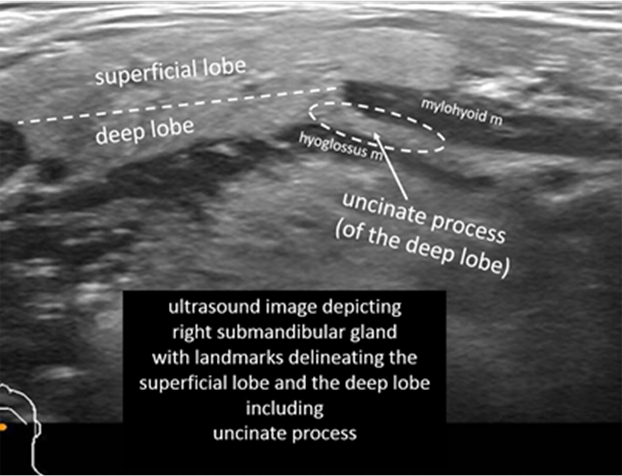 Proposal for standardized ultrasound analysis of the salivary glands: Part 1 submandibular gland