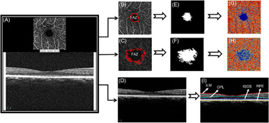 Vascular changes precede tomographic changes in diabetic eyes without retinopathy and improve artificial intelligence diagnostics