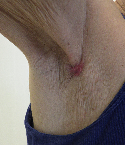 Ectopic axillary breast cancer in a male patient