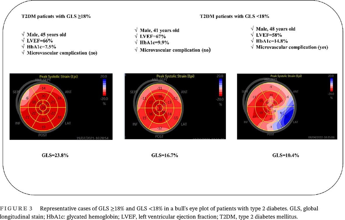 Assessment of subclinical left ventricular systolic dysfunction in patients with type 2 diabetes: Relationship with HbA1c and microvascular complications 2型糖尿病患者亚临床左心室收缩功能障碍的评估:与糖化血红蛋白和微血管并发症的关系