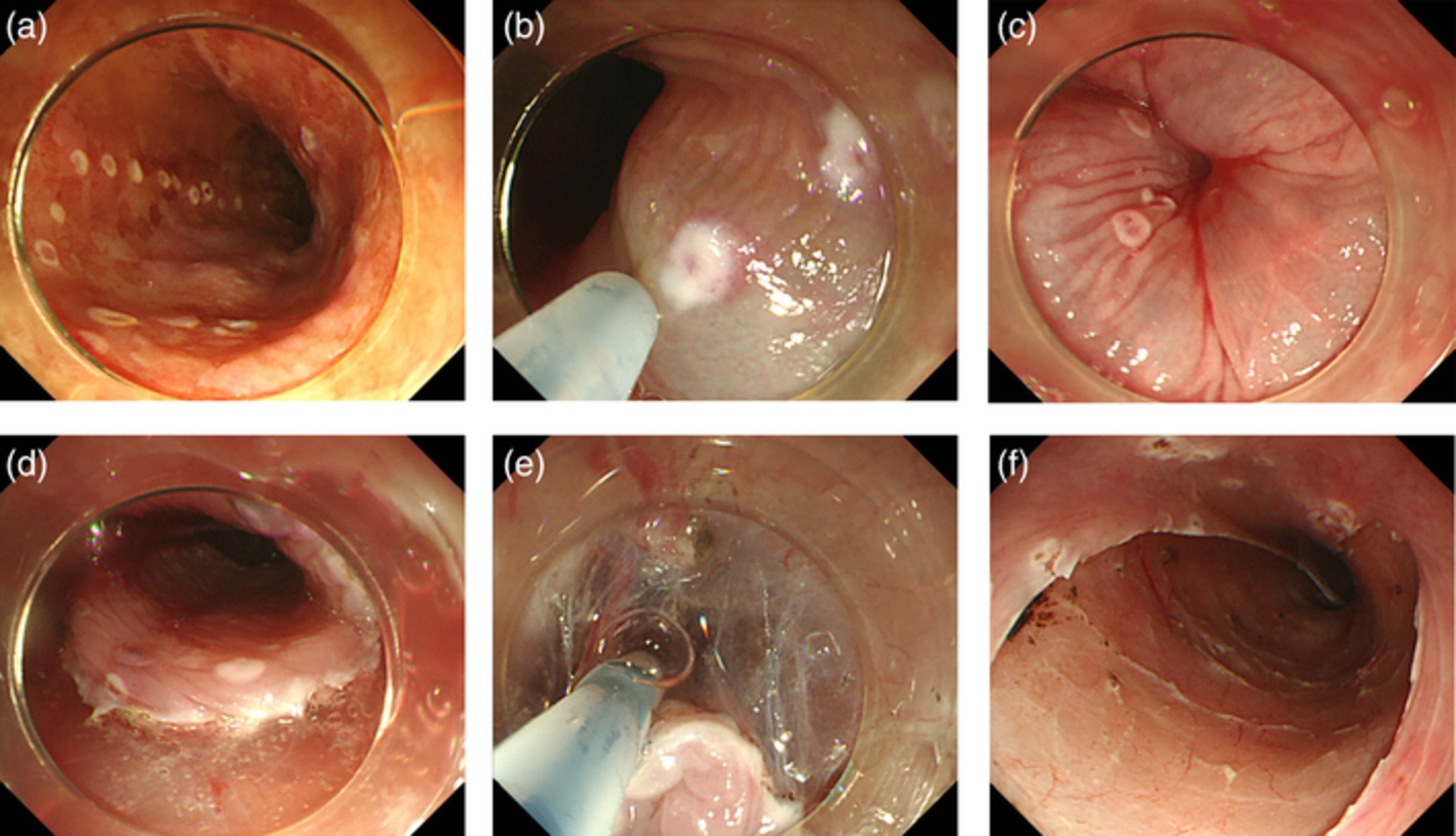 Feasibility of the lidocaine injection method during esophageal endoscopic submucosal dissection