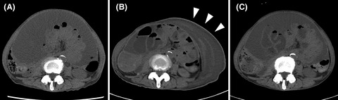 Subcutaneous edema as rare complication of abdominal paracentesis