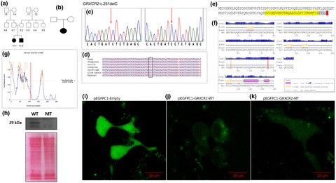 Whole exome sequencing reveals a biallelic frameshift mutation in GRXCR2 in hearing impairment in Cameroon