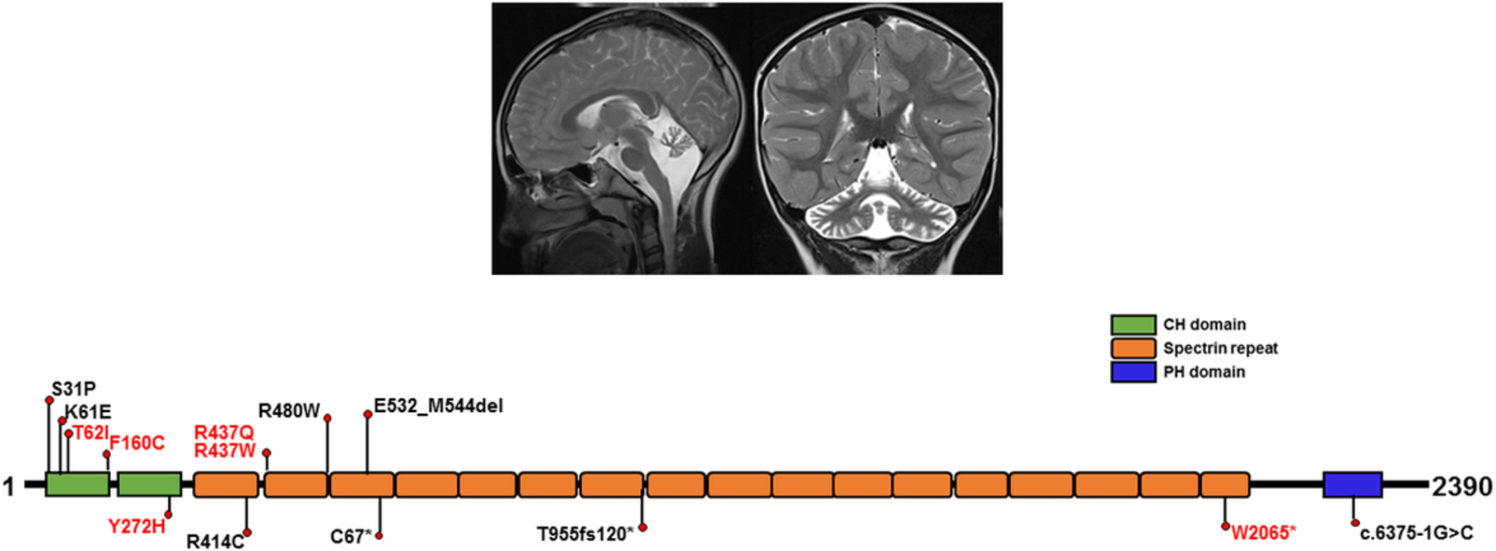 Heterozygous missense variants of SPTBN2 are a frequent cause of congenital cerebellar ataxia