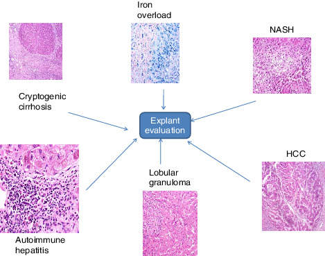 Explant liver evaluation decodes the mystery of cryptogenic cirrhosis!