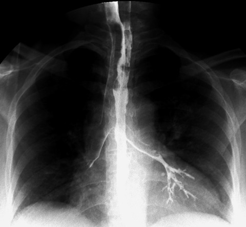 Barium aspiration - Accident or complication?