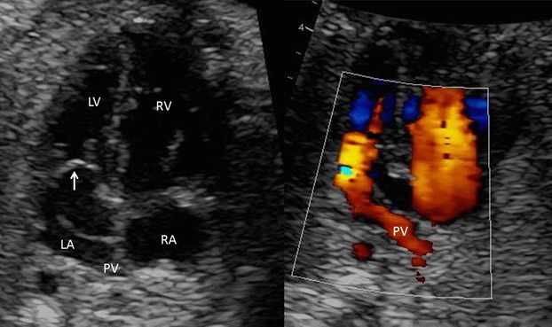Unusual consequence of a fetal atrial septal aneurysm