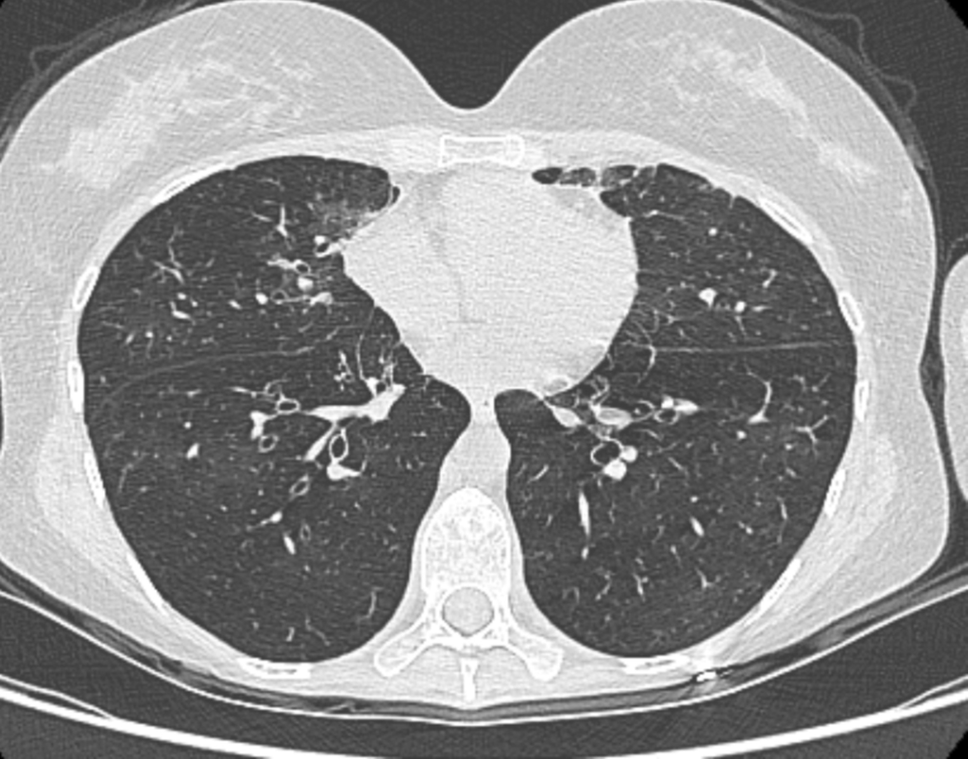 Successful treatment of severe post hematopoietic stem cell transplantation bronchiolitis obliterans syndrome with lung transplantation in a patient with multi-organ chronic graft-versus-host disease