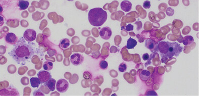 Hemophagocytic lymphohistiocytosis (HLH) and cytokine release syndrome (CRS) in a patient with oncogene-addicted metastatic non-small cell lung cancer (NSCLC) following combination chemotherapy-immunotherapy