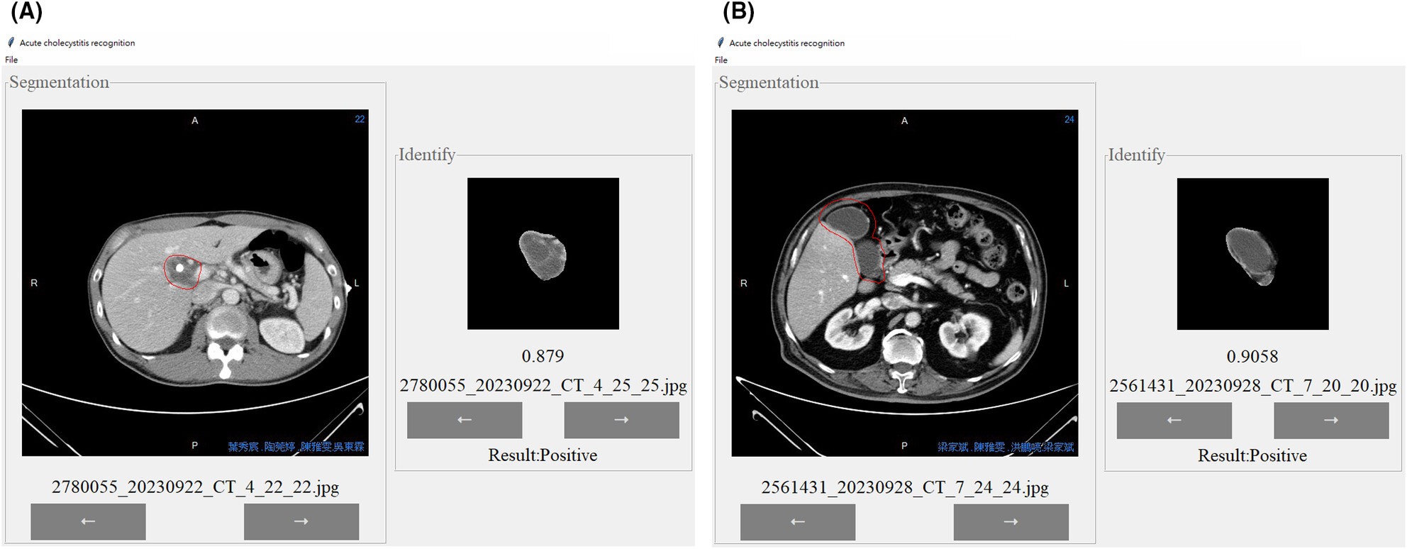 Automated CT image prescription of the gallbladder using deep learning: Development, evaluation, and health promotion