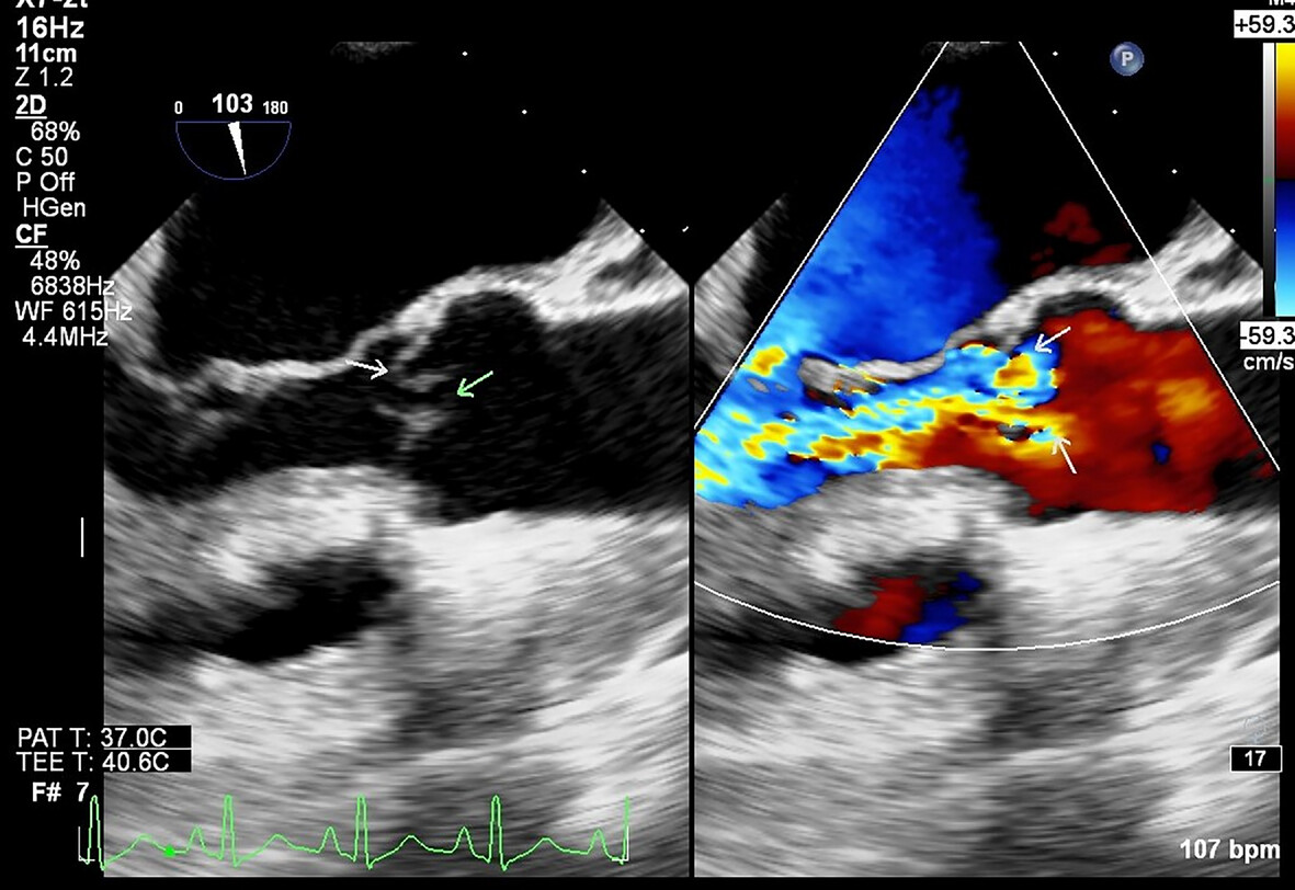 Rheumatoid Inflammation Causing Aortic Valve Perforation