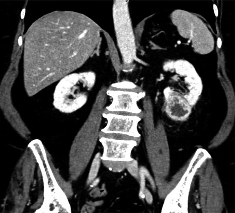 Sporadic renal hemangioblastoma: A case report of a rare benign renal tumor