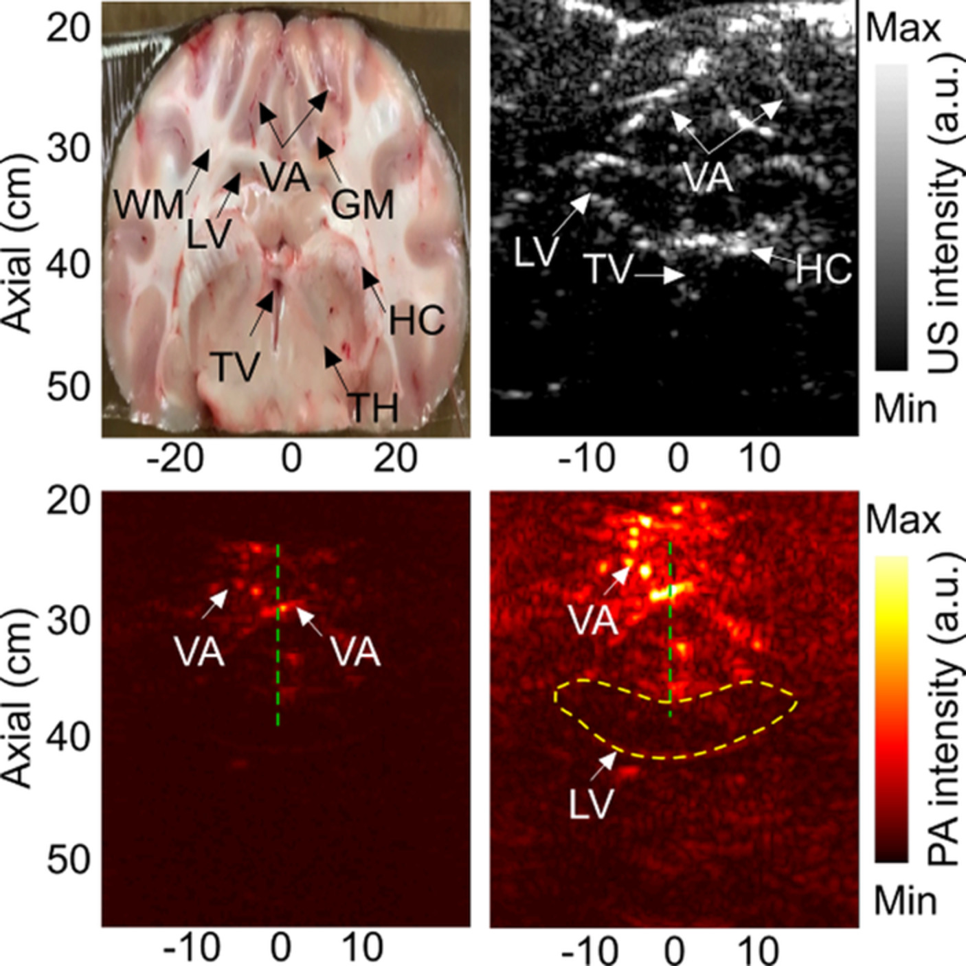 Deep learning protocol for improved photoacoustic brain imaging