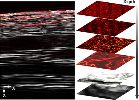 Photoacoustic and ultrasound (PAUS) dermoscope with high sensitivity and penetration depth by using a bimorph transducer